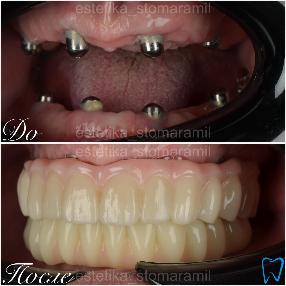 implantacziya foto 2 Имплантация фото (2)