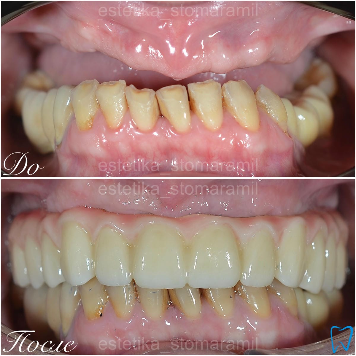 implantacziya foto 3 Имплантация фото (3)