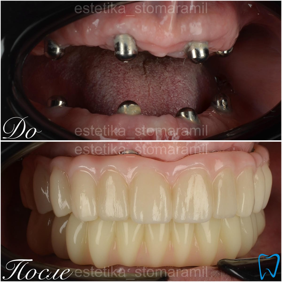 implantacziya foto 4 Имплантация фото (4)