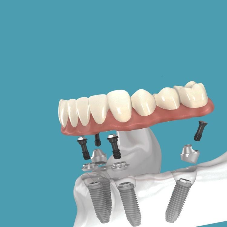 protezirovanie all on 4 2 | Стоматология в Арамиле